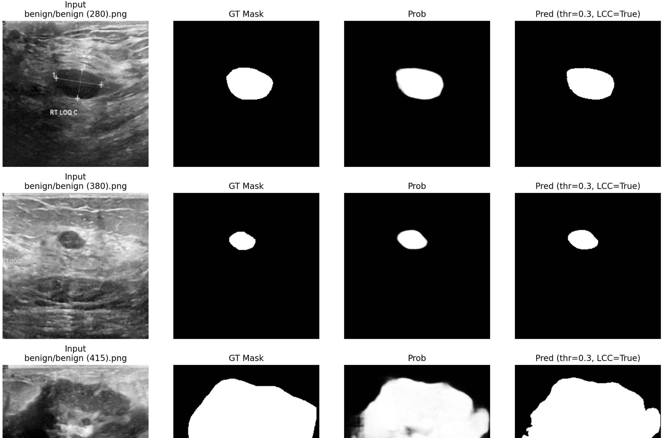 BREAST ULTRASOUND LESION SEGMENTATION